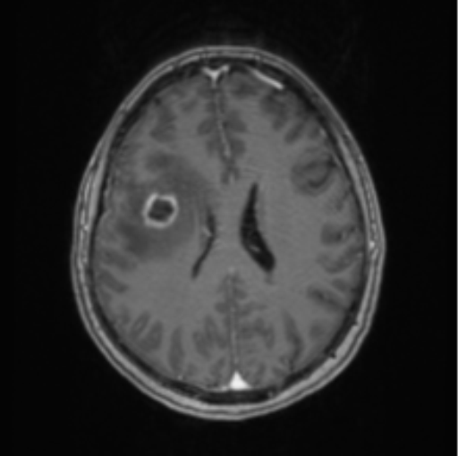 Cerebral abscess from pulmonary arteriovenous malformation (Radiopaedia 86275-102291 Axial T1 C+ 48).png