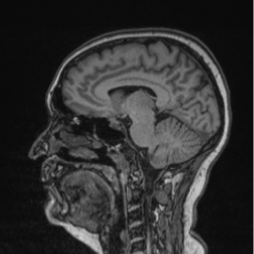 Cerebral abscess from pulmonary arteriovenous malformation (Radiopaedia 86275-102291 Sagittal T1 49).png