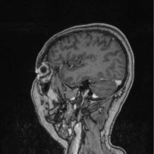Cerebral abscess from pulmonary arteriovenous malformation (Radiopaedia 86275-102291 Sagittal T1 C+ 20).png