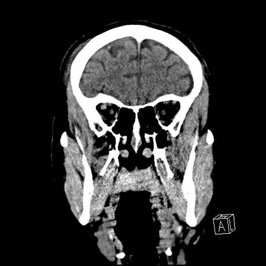 File:Cerebral abscess with ventriculitis (Radiopaedia 78965-91876 B 14).jpg
