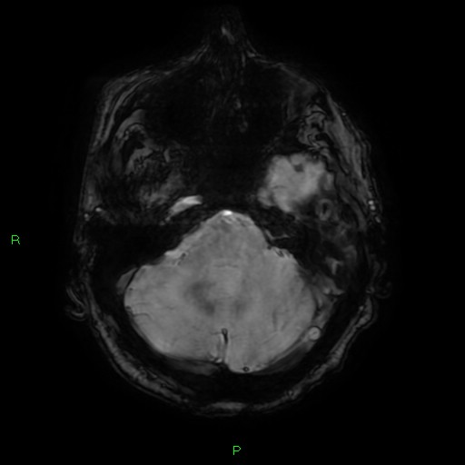 File:Cerebral amyloid angiopathy-associated lobar intracerebral hemorrhage (Radiopaedia 58376-65512 Axial SWI 15).jpg