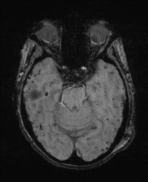 File:Cerebral amyloid angiopathy-related inflammation (Radiopaedia 74836-85849 Axial SWI 25).jpg