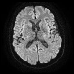 File:Cerebral amyloid angiopathy (Radiopaedia 28698-28978 Axial DWI 16).jpg