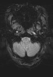 File:Cerebral amyloid angiopathy (Radiopaedia 29129-29518 Axial SWI MPR 3).jpg