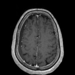 Cerebral amyloid angiopathy (Radiopaedia 29129-29518 Axial T1 C+ 112).jpg
