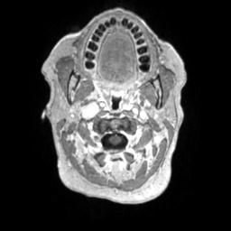 Cerebral amyloid angiopathy (Radiopaedia 29129-29518 Axial T1 C+ 3).jpg
