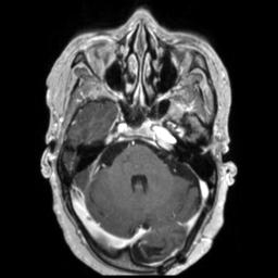 Cerebral amyloid angiopathy (Radiopaedia 29129-29518 Axial T1 C+ 43).jpg