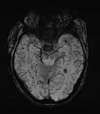 Cerebral amyloid angiopathy (Radiopaedia 46082-50433 Axial SWI MIP 29).png