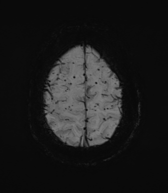 Cerebral amyloid angiopathy (Radiopaedia 46082-50433 Axial SWI MIP 68).png