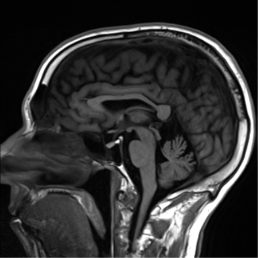 File:Cerebral amyloid angiopathy (Radiopaedia 46082-50433 Sagittal T1 14).png