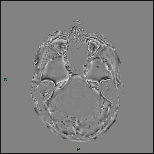 Cerebral amyloid angiopathy (Radiopaedia 77506-89664 H 34).jpg
