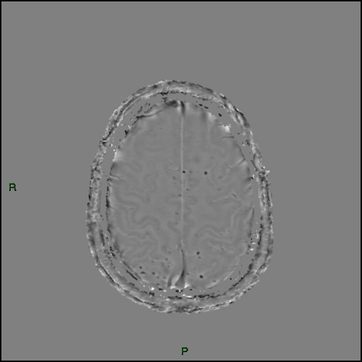 Cerebral amyloid angiopathy (Radiopaedia 77506-89664 H 84).jpg