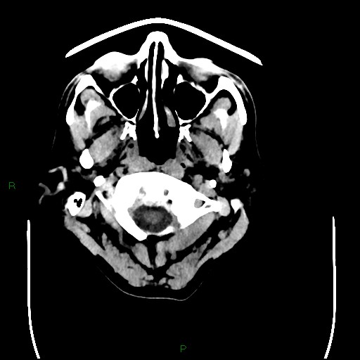 File:Cerebral amyloid angiopathy (Radiopaedia 77506-89665 Axial non-contrast 1).jpg