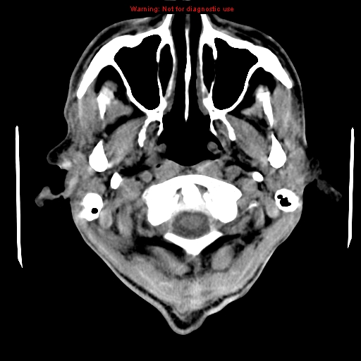 File:Cerebral and orbital tuberculomas (Radiopaedia 13308-13310 Axial non-contrast 1).jpg