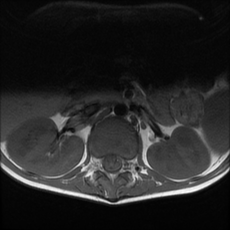File:Cerebral and spinal tuberculosis (Radiopaedia 90489-107912 Axial T1 2).jpg