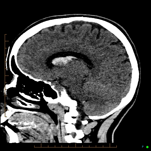 Cerebral arteriovenous malformation (AVM) (Radiopaedia 78162-90706 A 45).jpg