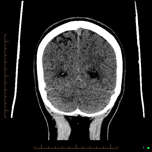 Cerebral arteriovenous malformation (AVM) (Radiopaedia 78162-90706 Coronal non-contrast 78).jpg