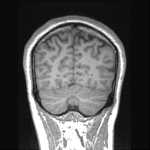 Cerebral arteriovenous malformation (Radiopaedia 39259-41506 Coronal T1 22).png