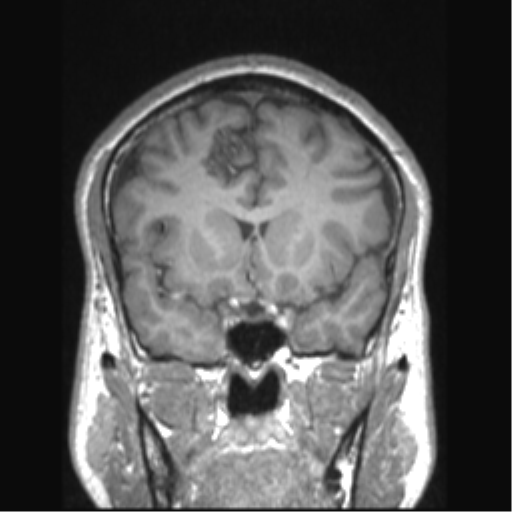Cerebral arteriovenous malformation (Radiopaedia 39259-41506 Coronal T1 60).png