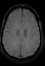 File:Cerebral arteriovenous malformation (Radiopaedia 55798-62372 Axial SWI 27).png