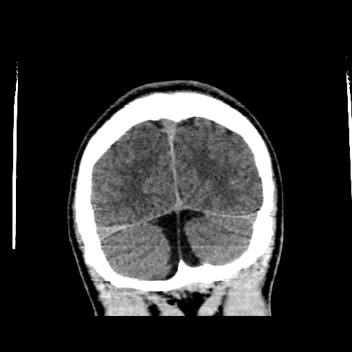 File:Cerebral arteriovenous malformation (Radiopaedia 61964-70028 Coronal non-contrast 53).jpg
