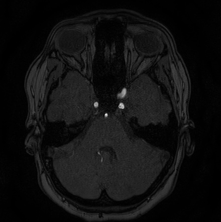 Cerebral arteriovenous malformation (Radiopaedia 74411-85654 Axial MRA 26).jpg