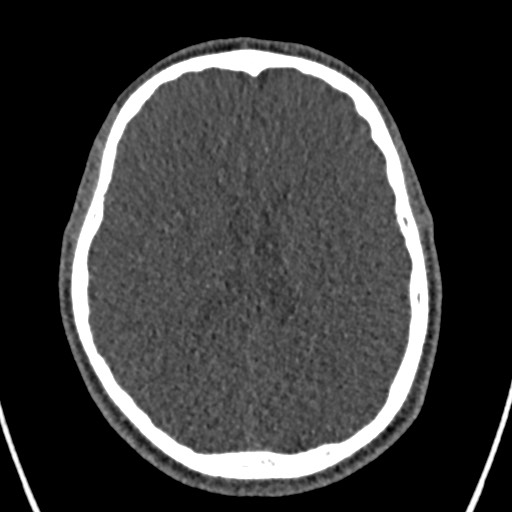 Cerebral arteriovenous malformation (Radiopaedia 78188-90746 Axial non-contrast 108).jpg