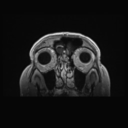 Cerebral arteriovenous malformation (Radiopaedia 84015-99245 Coronal T1 C+ 21).jpg