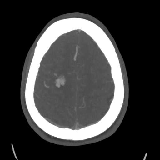 Cerebral arteriovenous malformation (Spetzler-Martin grade 2) (Radiopaedia 41262-44076 E 43).png