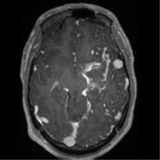 Cerebral arteriovenous malformation - huge (Radiopaedia 35734-37272 Axial T1 C+ 29).png