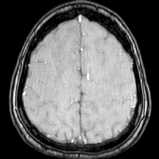 Cerebral arteriovenous malformation at posterior body of corpus callosum (Radiopaedia 74111-84925 Axial MRA 177).jpg