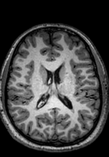 Cerebral arteriovenous malformation at posterior body of corpus callosum (Radiopaedia 74111-84925 Axial T1 118).jpg