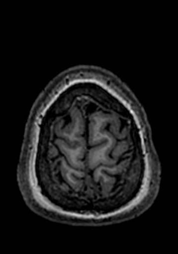 Cerebral arteriovenous malformation at posterior body of corpus callosum (Radiopaedia 74111-84925 Axial T1 12).jpg
