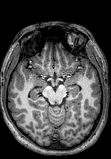Cerebral arteriovenous malformation at posterior body of corpus callosum (Radiopaedia 74111-84925 Axial T1 185).jpg