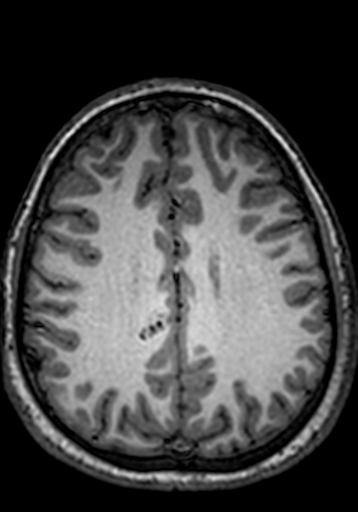 File:Cerebral arteriovenous malformation at posterior body of corpus callosum (Radiopaedia 74111-84925 Axial T1 91).jpg
