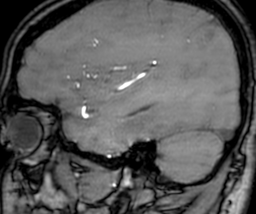 Cerebral arteriovenous malformation at posterior body of corpus callosum (Radiopaedia 74111-84925 J 306).jpg