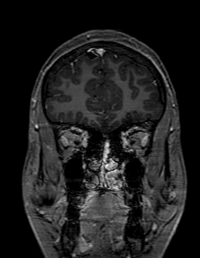 Cerebral arteriovenous malformation at posterior body of corpus callosum (Radiopaedia 74111-84925 K 63).jpg