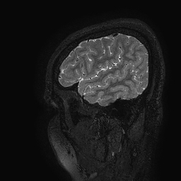 Cerebral arteriovenous malformation at posterior body of corpus callosum (Radiopaedia 74111-84925 Sagittal T2 121).jpg