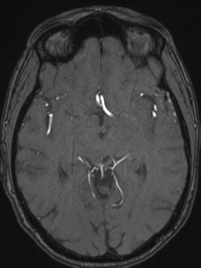 Cerebral arteriovenous malformation with hemorrhage (Radiopaedia 34422-35737 Axial MRA 37).png