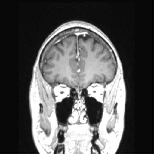 Cerebral arteriovenous malformation with hemorrhage (Radiopaedia 34422-35737 Coronal T1 C+ 72).png