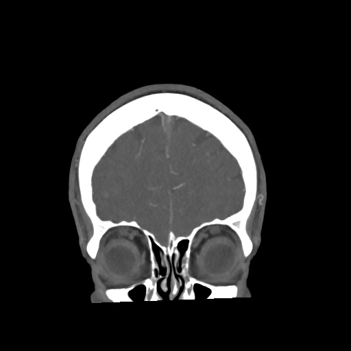 Cerebral arteriovenous malformation with lobar hemorrhage (Radiopaedia 35598-57216 C 16).jpg