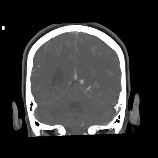 Cerebral arteriovenous malformation with lobar hemorrhage (Radiopaedia 35598-57216 C 66).jpg