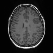 File:Cerebral cavernous venous malformation (Radiopaedia 70008-80021 Axial T1 51).jpg