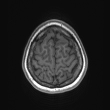 Cerebral cavernous venous malformation (Radiopaedia 70008-80021 Axial T1 81).jpg