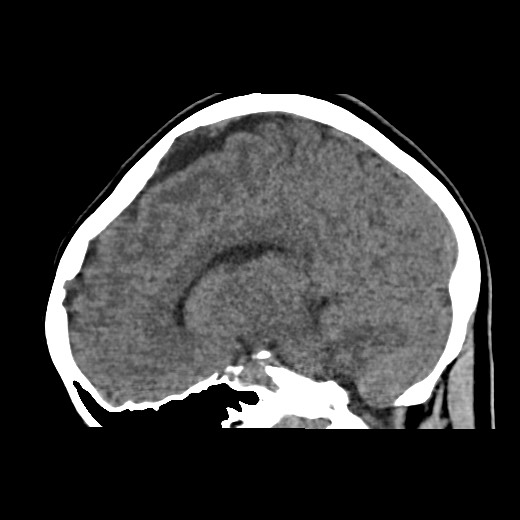 File:Cerebral cavernous venous malformation (Radiopaedia 70008-80022 C 25).jpg