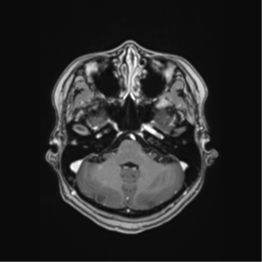 Cerebral cavernous venous malformations (Radiopaedia 48117-52946 Axial T1 C+ 9).png