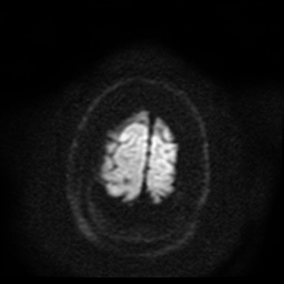 Cerebral embolic infarcts (embolic shower) (Radiopaedia 49837-55108 Axial DWI 52).jpg