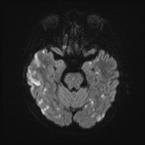 Cerebral embolic infarcts (embolic shower) (Radiopaedia 72391-82921 Axial DWI 40).jpg