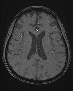 Cerebral embolic infarcts (embolic shower) (Radiopaedia 72391-82921 Axial MRA 119).jpg