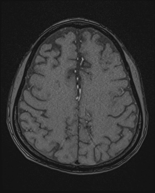 Cerebral embolic infarcts (embolic shower) (Radiopaedia 72391-82921 Axial MRA 149).jpg